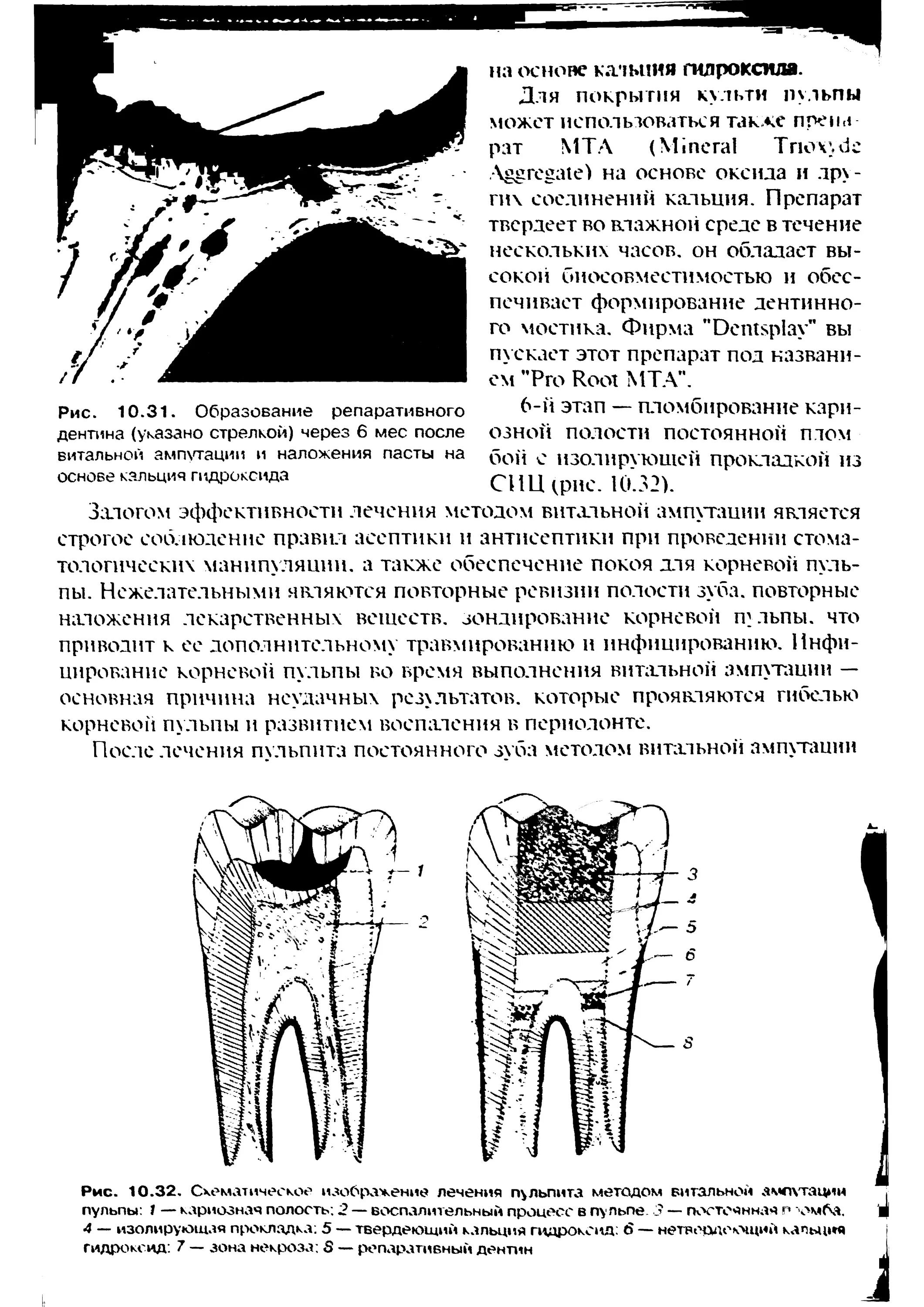 Витальная ампутация пульпита. Пульпит метод витальной ампутации. Витальная ампутация пульпы. Показания к витальной ампутации пульпы.