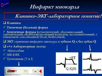 Варианты инфаркта миокарда