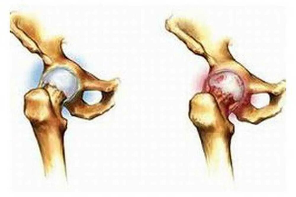Тазобедренный артрит у ребенка. Септический артрит тазобедренного сустава. Ревматоидный артрит тазобедренного сустава. Артрит суставов тазобедренного сустава симптомы. Реактивный коксит тазобедренного сустава.