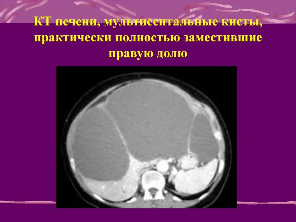 Непаразитарные кисты печени кт. Кисты правой доли печени кт. Кт норма печень