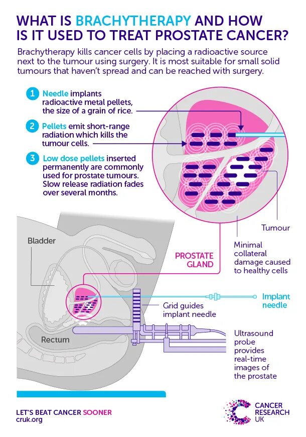 Брахитерапия (внутритканевая лучевая терапия). Контактная лучевая терапия брахитерапия это. Аппликаторы для брахитерапии. Брахитерапия простаты цена