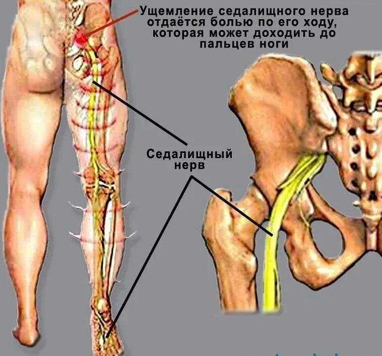 Мышца седалищного нерва. Анатомия седалищного нерва у человека. Седалищный нерв схема. Заземление седалищный нерв. Седалищный и бедренный нерв.