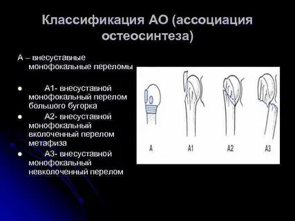 Остеосинтез классификация