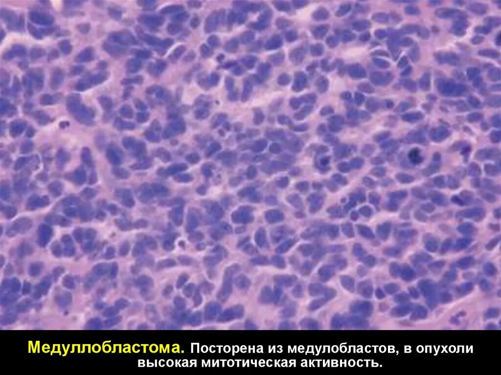 Медуллобластома это. Медуллобластома это