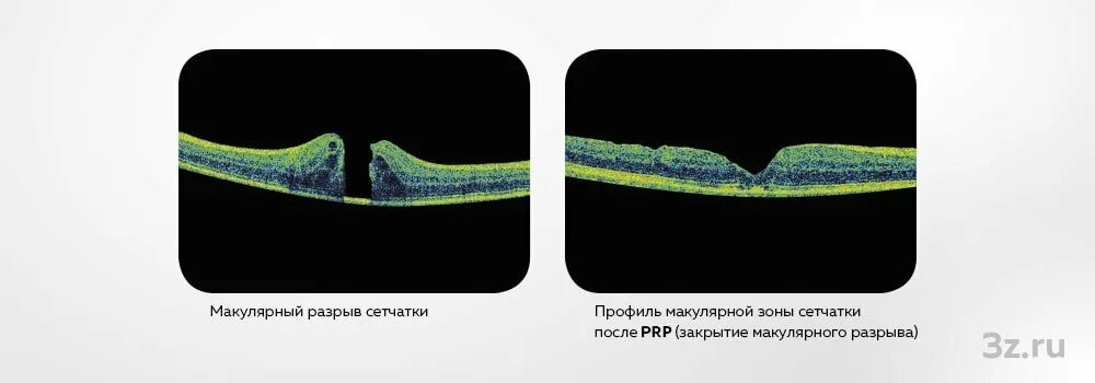 Ламеллярный макулярный разрыв. Макулярный разрыв. Ламеллярный разрыв.. Макулярный разрыв отслойка сетчатки. Макулярный разрыв сетчатки ОСТ. Макулярный разрыв после операции