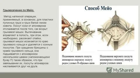 Пупочная грыжа методы операции