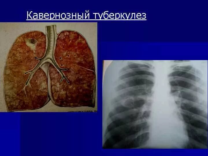 Туберкулез легких