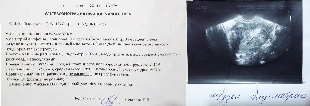 Эндометрий при тамоксифене. Миома матки УЗИ протокол. Киста шейки матки УЗИ протокол. УЗИ органов малого таза киста яичника. Заключение УЗИ воспаление яичника.