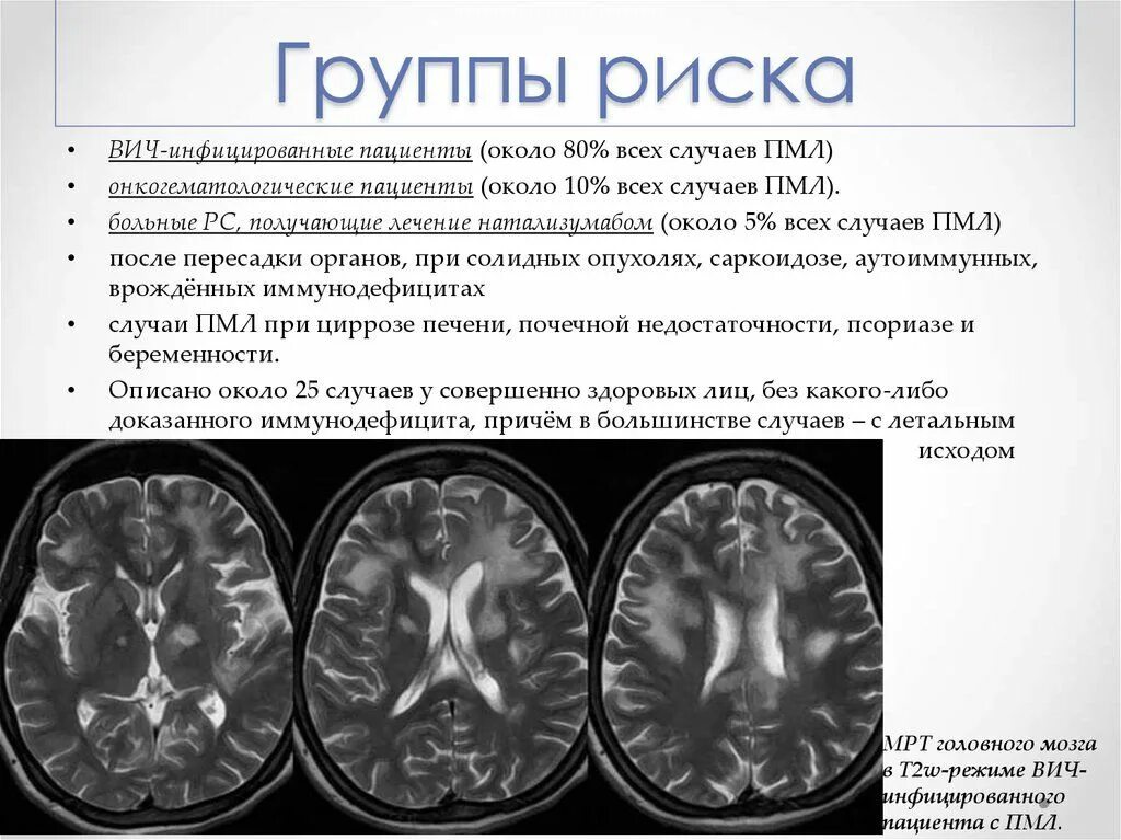 Поражение головного мозга у взрослых. Прогрессирующая мультифокальная лейкоэнцефалопатия (ПМЛ). Прогрессирующая мультифокальная лейкоэнцефалопатия мрт. Лейкоэнцефалопатия головного мозга кт. ПМЛ мрт прогрессирующая мультифокальная лейкоэнцефалопатия.