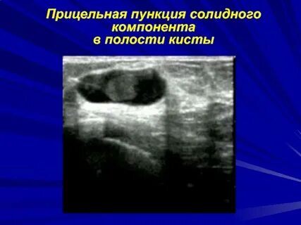 Кистозная полость