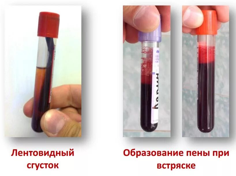 Как должна выглядеть кровь Типы артериальной крови