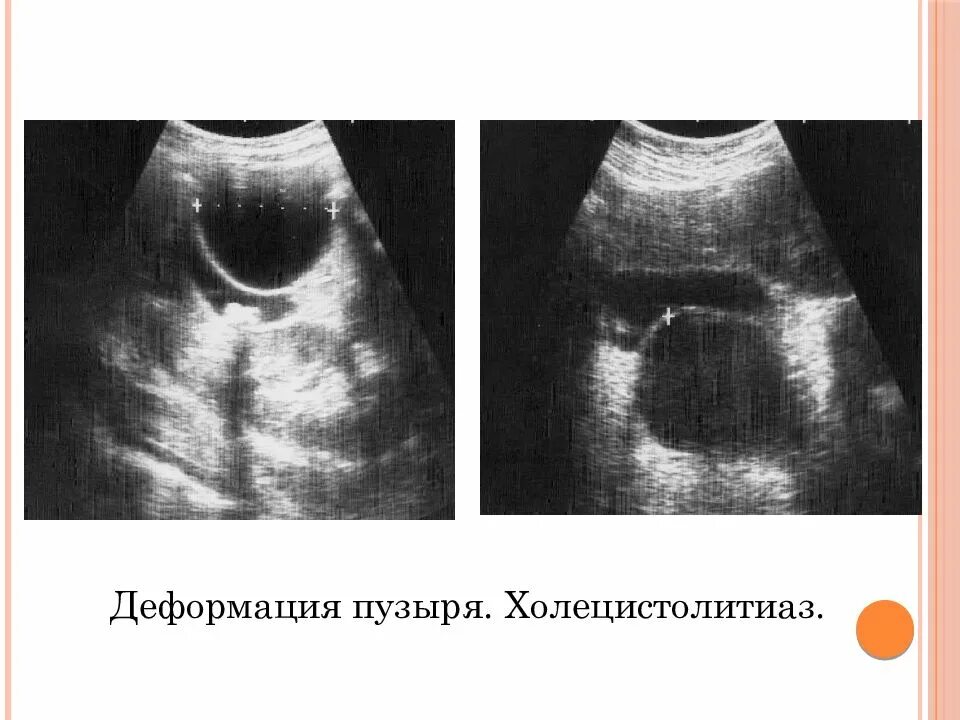 Холестероз и холецистит. Острый холецистит определение. Холецистолитиаз желчного пузыря что это. Желчекаменная болезнь лекция. Холецистолитиаз желчного пузыря что это.