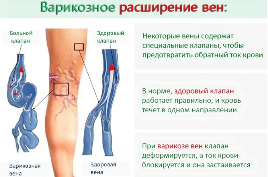 Помощь венам