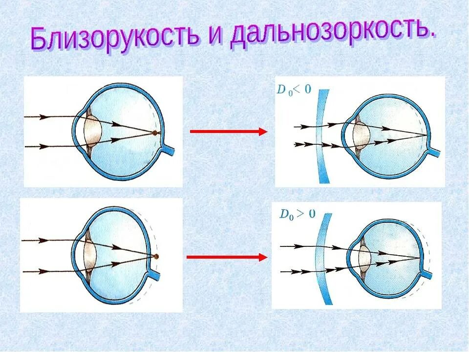 Дальнозоркость что делать. Что такое близорукость (миопия) и дальнозоркость (гиперметропия). Зрительный анализатор дальнозоркость и близорукость. Близорукость и дальнозоркость таблица. Дальнозоркость и близорукость плюс и минус.