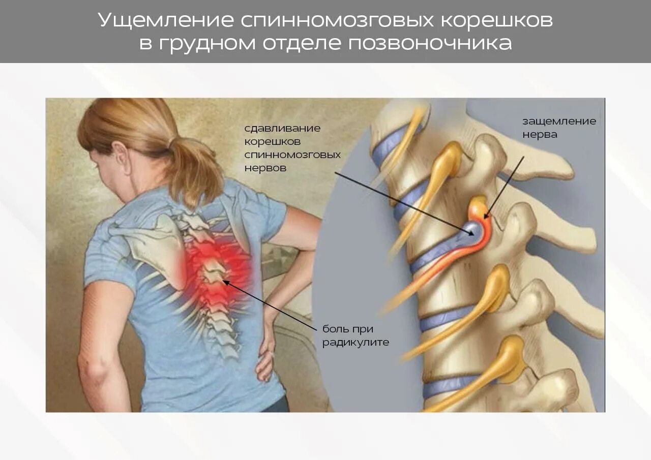 Радикулопатия справа. Дорсопатия шейно-грудного отдела позвоночника что это такое. Дорсопатии грудного отдела позвоночника. Шейная радикулопатия. Дорсопатия шейного и грудного отдела.