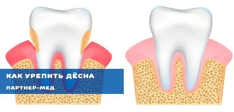 Примочки для укрепления зубов. Укрепление дёсен и шатающихся зубов.