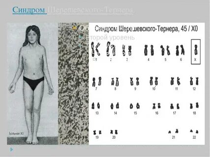 Симптомы шерешевского тернера