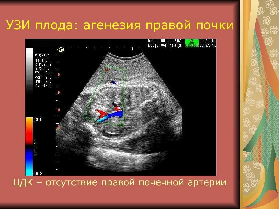 Мультикистозная почек плода. Мультикистозная почек плода