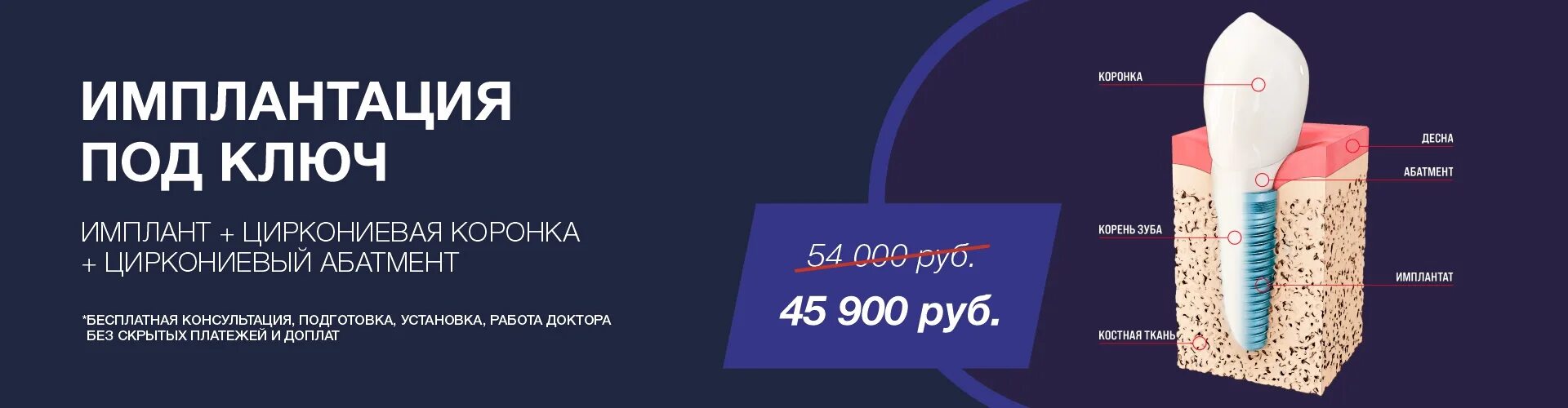 Импланты под ключ нижний новгород. Акции по стоматологии. Импланты лендинг. Импланты под ключ нижний новгород. Имплантация реклама.