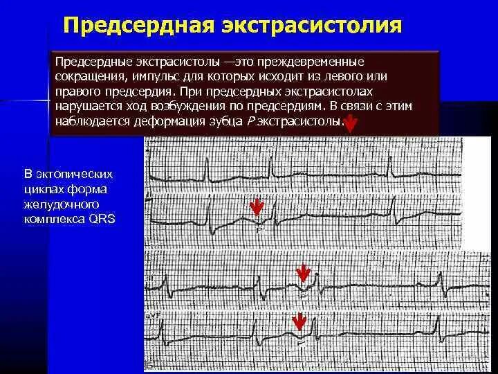 Блокированная наджелудочковая экстрасистолия на ЭКГ. Экстрасистолия предсердий на ЭКГ. Предсердная экстрасистолия на ЭКГ. Предсердные экстрасистолы на ЭКГ. Экстрасистолы врачам