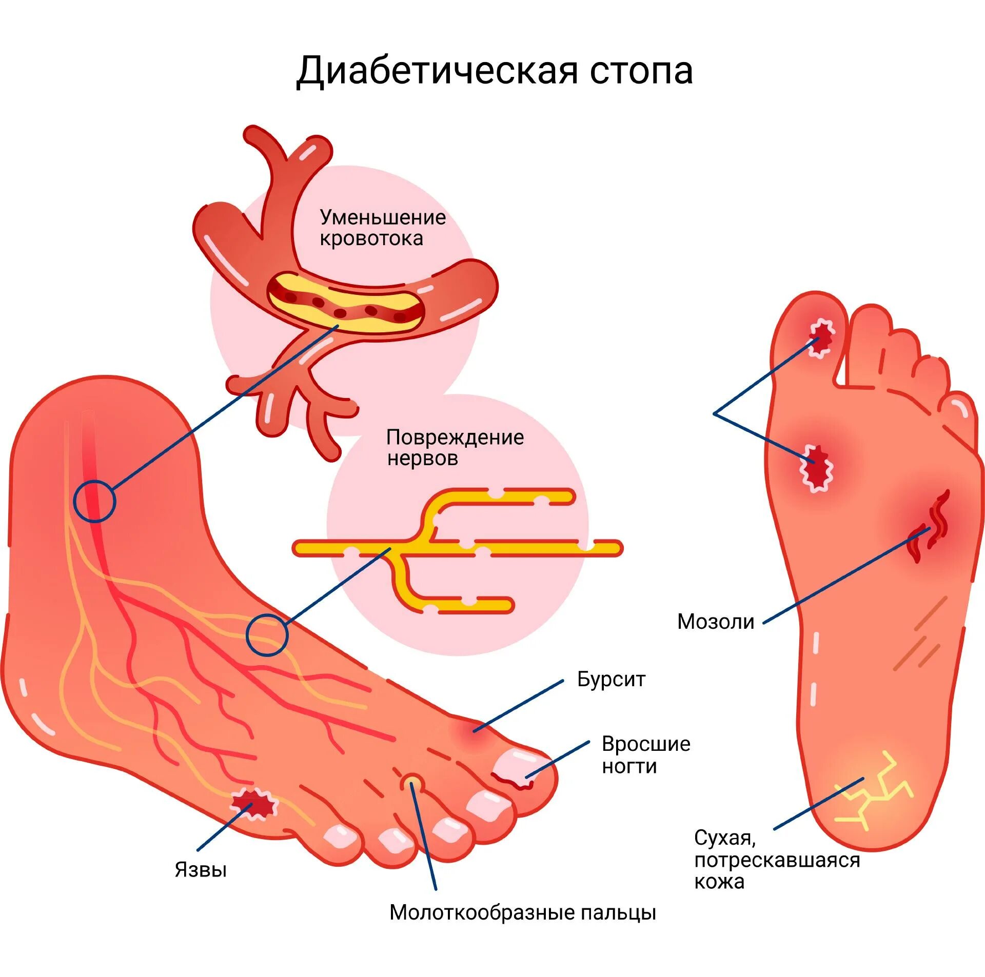 Диабетическая стопа клиника. Стопа при сахарном диабете.