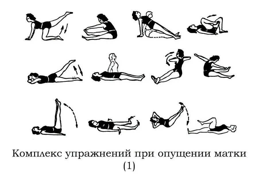 Ощущение выпадение матки как это наглядный пример Выпадение матки в пожилом возрасте найдено 90 картинок