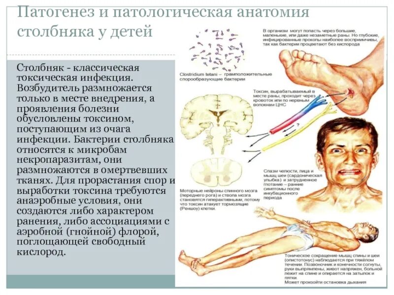 Сколько нельзя мочить столбняк. Столбняк очаги поражения. Схема заражения столбняком. Возбудитель столбняка симптомы. Столбняк пути симптомы.