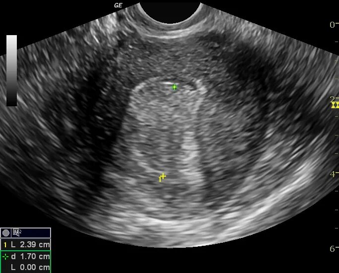 Киста яичника УЗИ трансабдоминальное. УЗИ картина полипа эндометрия. Эндометрий 3 мм