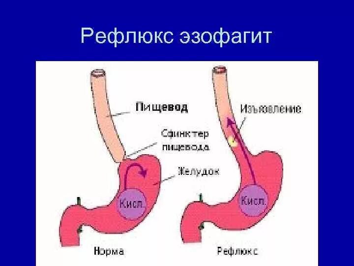 Рефлюкса купить. Клапан рефлюкс пищевода.