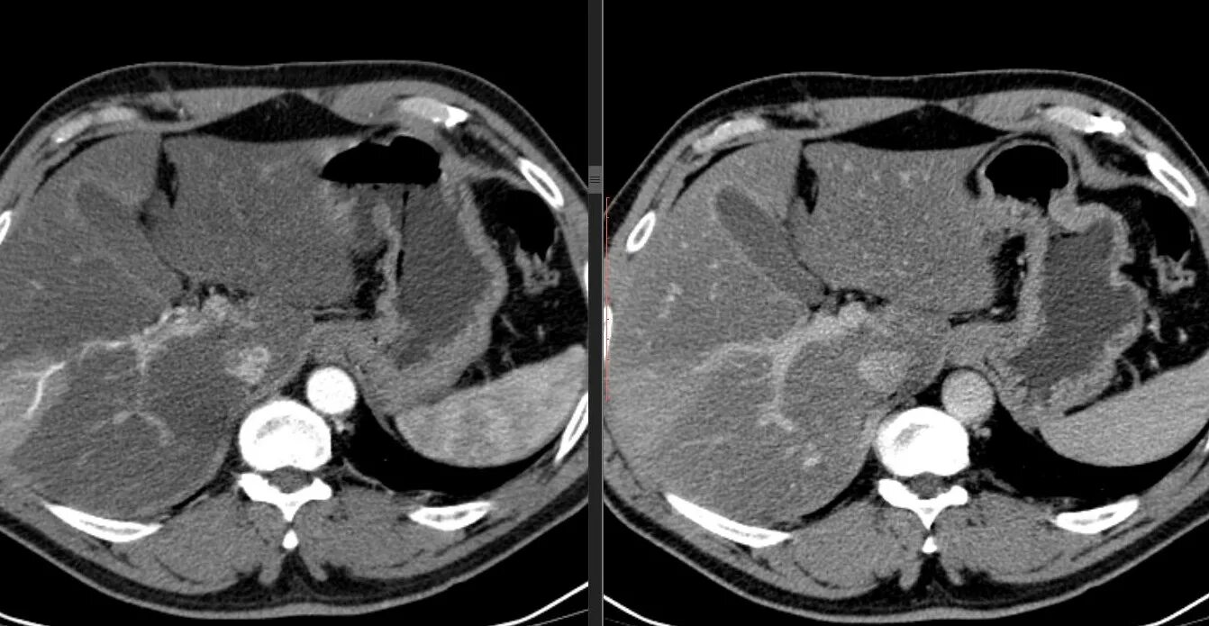 Гемангиома печени печени кт. Кавернозная гемангиома кт. Очаговые гемангиомы печени