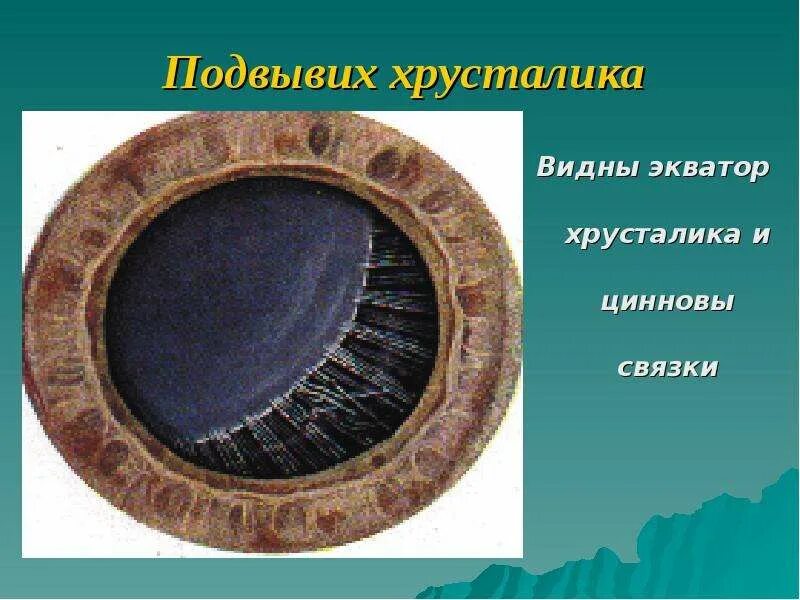 Вывих хрусталика. Сублюксация хрусталика. сублюксация хрусталика в стекловидное тело.