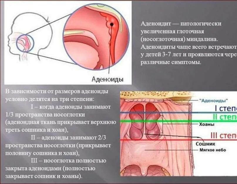 Аденоиды это разрастание лимфоидной ткани. Носоглоточные аденоиды. Симптомы разросшихся аденоидов. Аденоидные вегетации 1