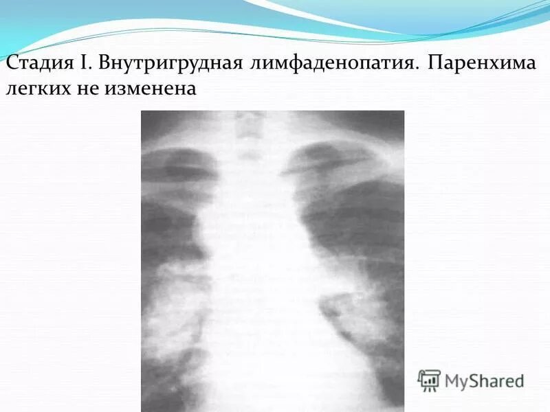 Лимфаденопатия средостения легких. Лимфаденопатия внутригрудных лимфоузлов рентген. Лимфаденопатия внутригрудных лимфоузлов средостения. Лимфаденопатия на рентгене легких. Синдром внутригрудной лимфаденопатии.