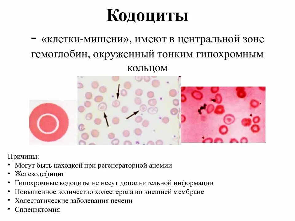 Патологические формы эритроцитов. Эритроциты мишеневидной формы. талассемия эритроциты кодоциты. мишеневидные эритроциты механизм возникновения. эритроциты в форме мишени.