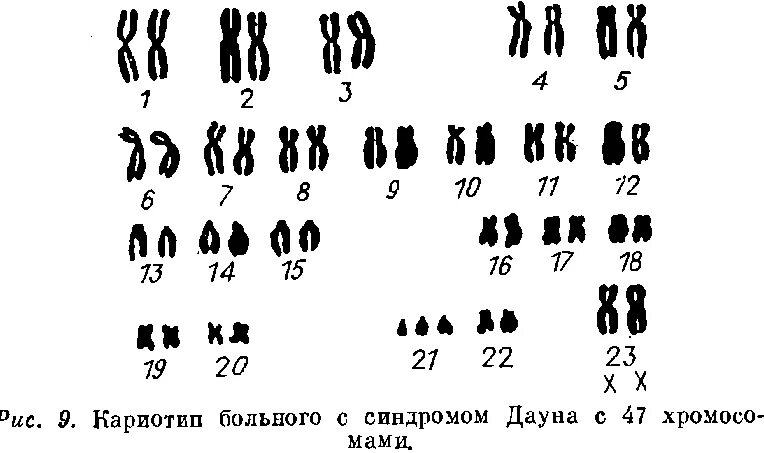 Кариотип человека при синдроме Дауна. Кариотип больного с синдромом Дауна. Кариотип болезни синдрома Дауна. Синдром Дауна трисомия 21 хромосомы. Наличие лишней хромосомы