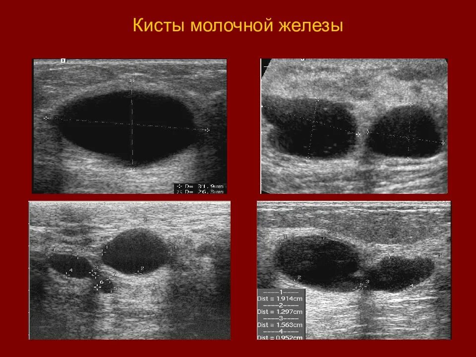 Кисты в молочных железах. Атипичная киста молочной железы. Киста молочной железы единичная.