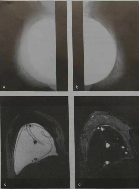 Имплант и мрт можно ли. Капсулярная контрактура грудного импланта мрт. Подкапсульный разрыв импланта мрт. Контрактура импланта молочной железы мрт. Капсулярная контрактура импланта молочной железы кт.