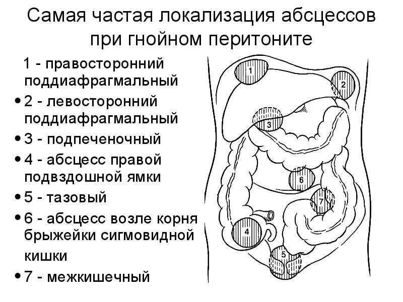 Локализация абсцессов брюшной полости аппендикулярного генеза. Локализация перитонита. Перитонит брюшной полости хирургия. Расположение абсцессов брюшной полости. Органы брюшной полости лечение