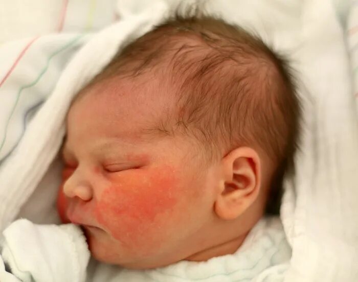 Почему младенцы красные. Физиологическая эритема новорожденных. Неонатальный пустулез новорожденных. Токсическая эритема новорожденного. Сыпь на лице у новорожденного.