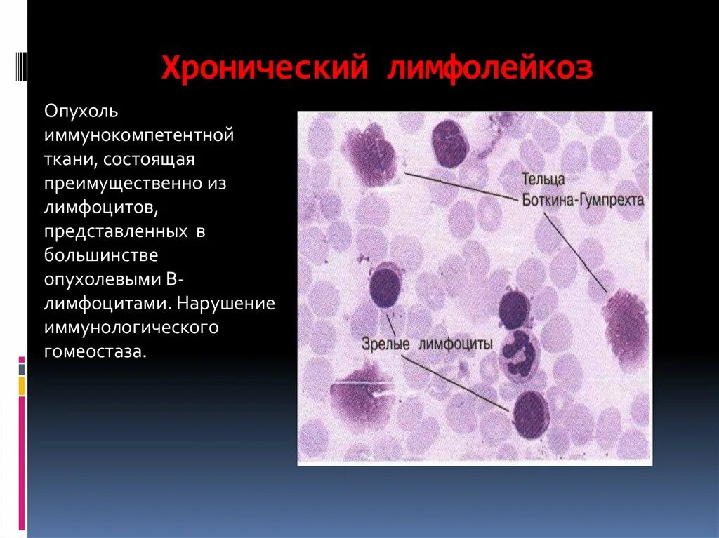 B хронический лимфолейкоз