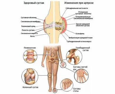 Артрит первые симптомы