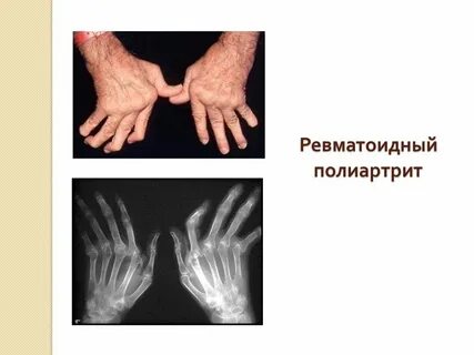 Полиартрит что это такое простыми словами