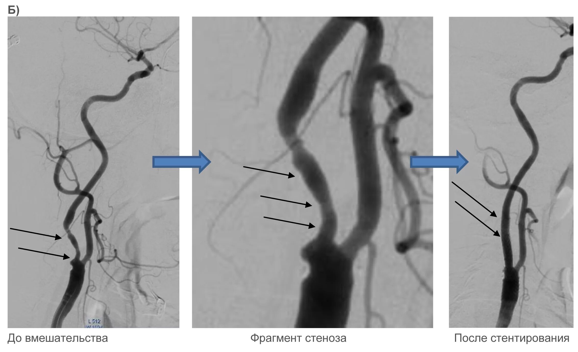 Стеноз устья вса. Стеноз внутренней сонной артерии кт. Стеноз сонной артерии ангиограмма. Стеноз внутренней сонной артерии стентирование. Стентирование коронарных артерий схема.