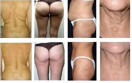 Липолитики целлюлит до после. Липолитики спб. Мпх липолитик 5 мл ампула мартинекс. Инъекционный липолиз от целлюлита. Лазерный липолиз для липосакции.