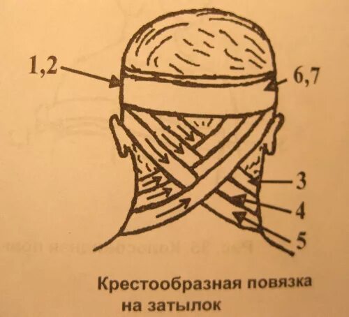 Крестообразная повязка. Повязка крестообразная повязка на затылок и шею десмургия. Восьмиобразная повязка на затылок алгоритм. Восьмиобразная повязка на затылок и шею. Наложение «восьмиобразной» повязки на затылок и шею.