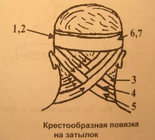 Повреждение затылка какая повязка. Крестообразная повязка на затылок и шею. Наложение восьмиобразной повязки на затылок. Десмургия. Повязка крестообразная на затылок.. Повязка крестовидная повязка на затылок.