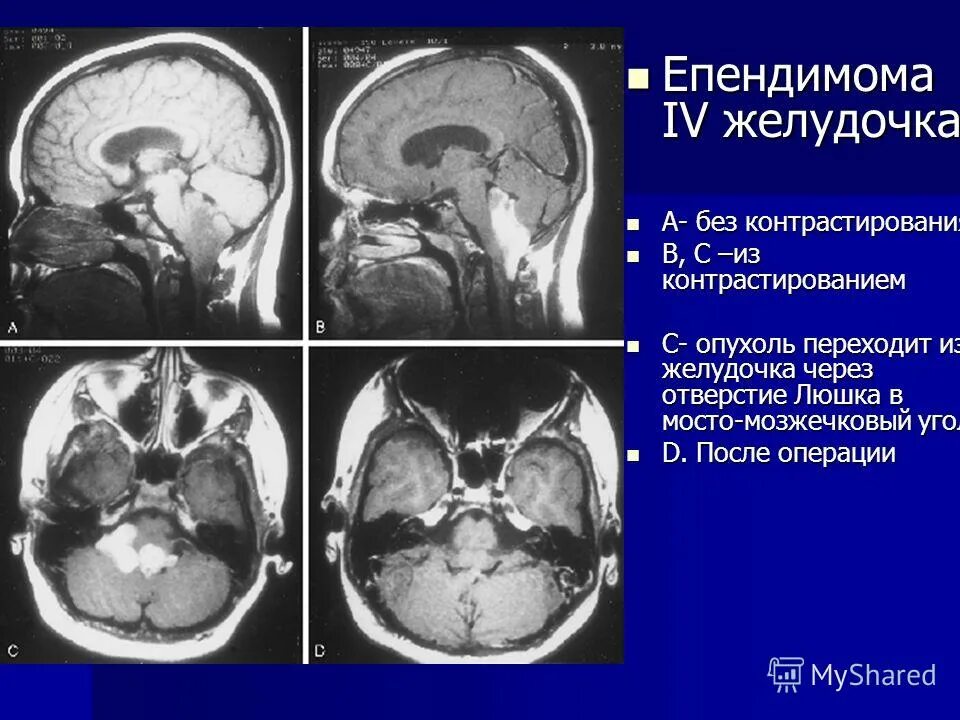 сильвиев водопровод анатомия. образование бокового желудочка головного мозга мрт. опухоль 4 желудочка головного мозга кт.