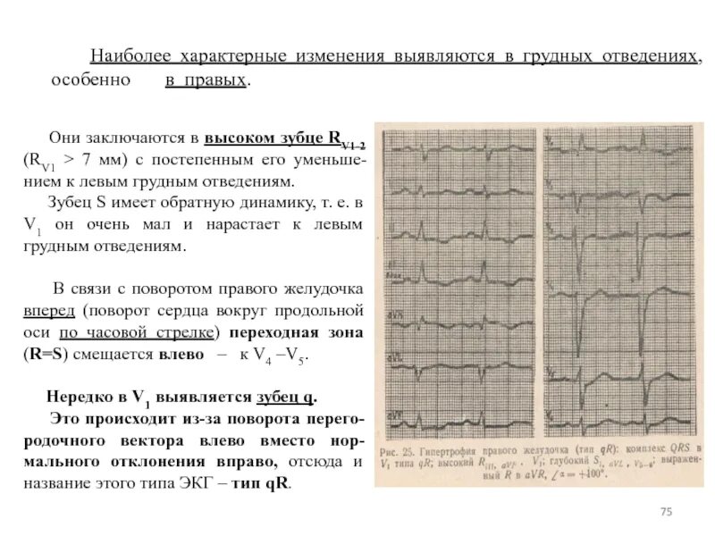 Нарастание зубца r. Зубец r в грудных отведениях. Высокий зубец т на ЭКГ В грудных отведениях. Глубокий зубец т на ЭКГ. Высокие зубцы т в грудных отведениях на ЭКГ У детей.