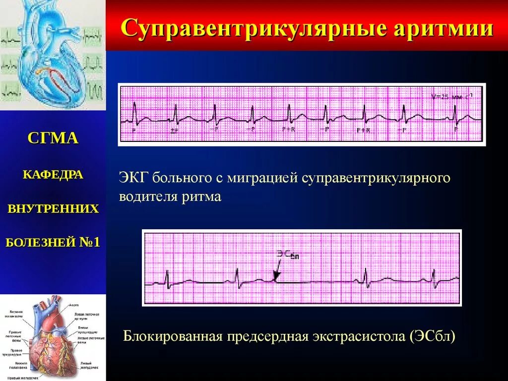 Нарушение ритма наджелудочковая экстрасистолия. Наджелудочковые аритмии классификация. Суправентрикулярная экстрасистолия экг критерии. Предсердные экстрасистолы на экг. Аритмия и экстрасистолия на экг.