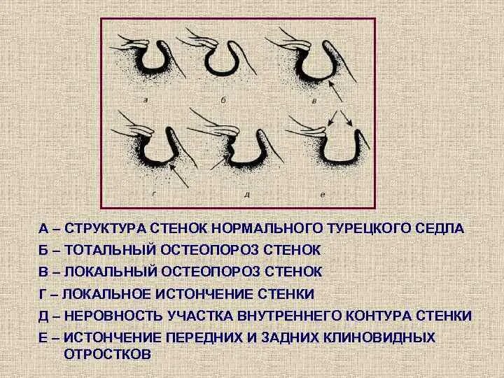 Спинка турецкого седла. Турецкое седло рентген описание. остеопороз спинки турецкого седла. аномалии турецкого седла. формы турецкого седла.